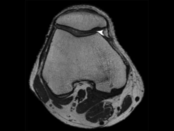 MSK View T2w TSE Axial Reformat