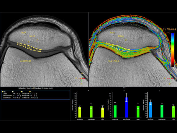 Axial T2w Calc. TSE