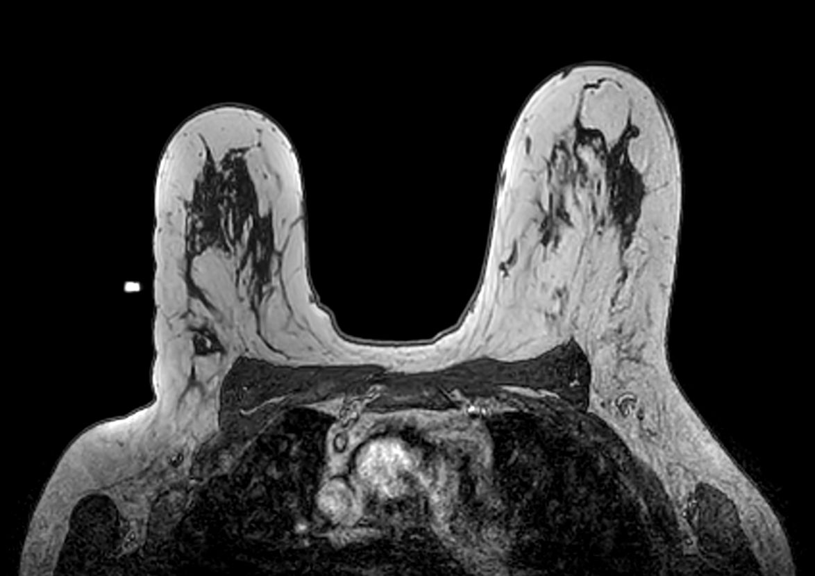 Axial dynamic 3D T1w FFE