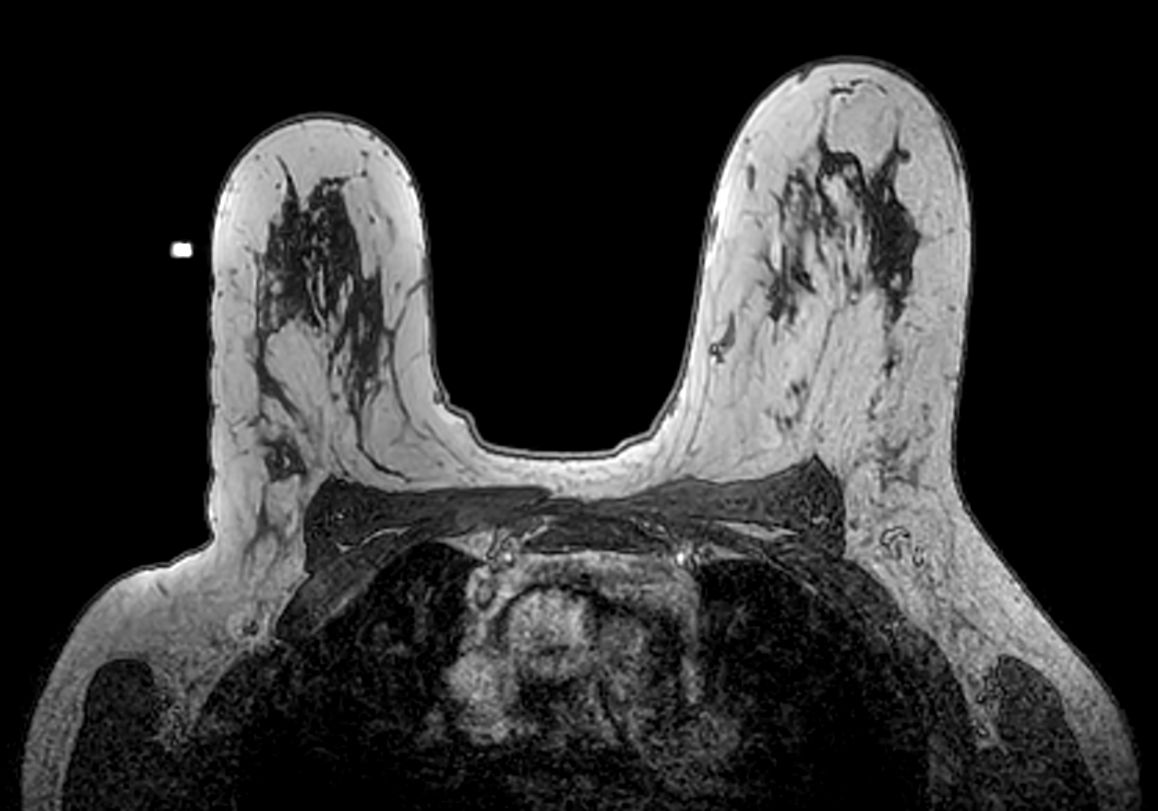 Axial 3D T1w FFE - Confirmation Fudicial marker positioning too high