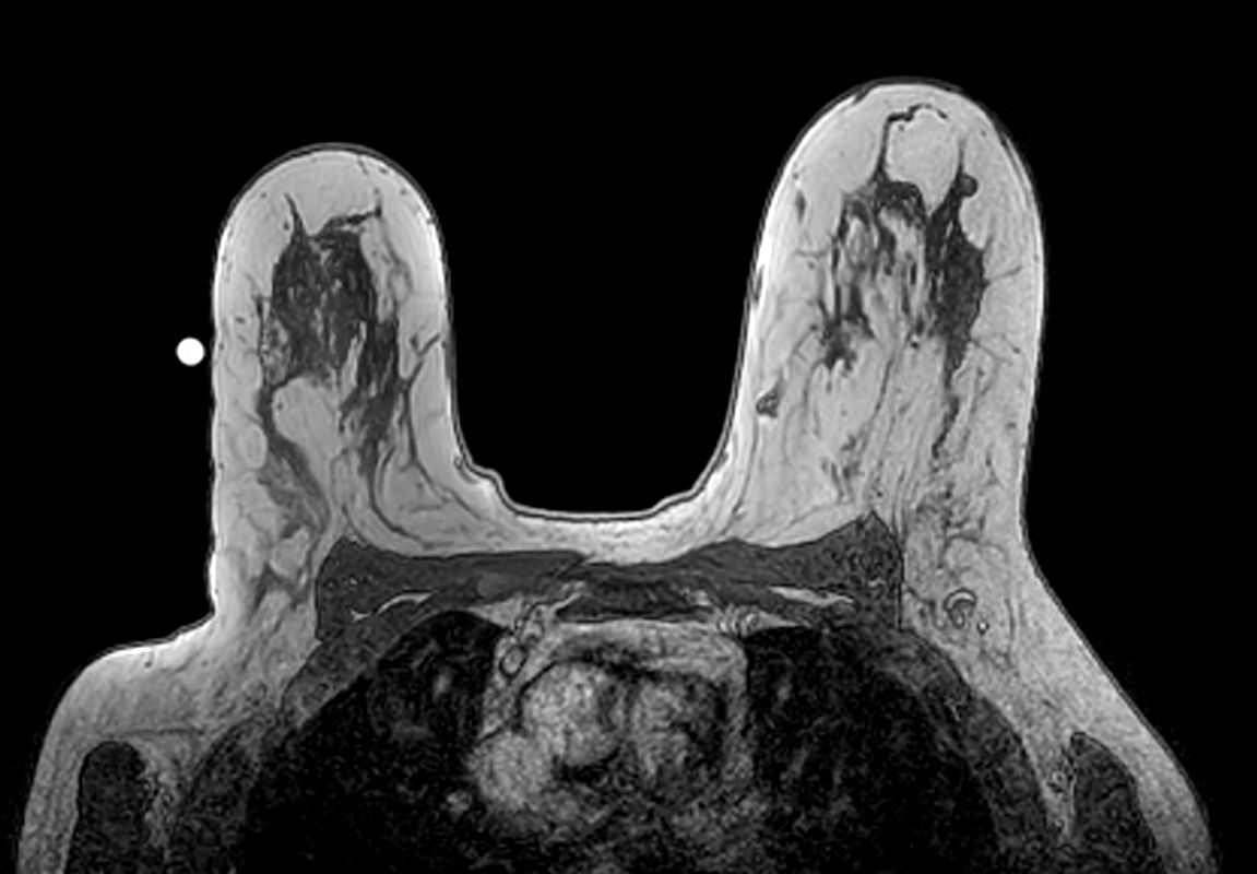 Axial 3D T1w FFE - Confirmation Fiducial marker positioning correct