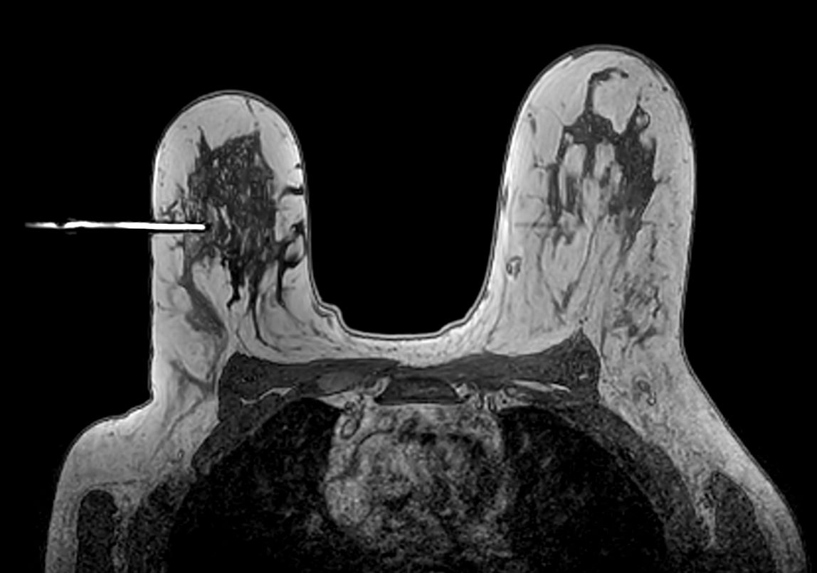 Axial 3D T1w FFE Needle positioning too deep
