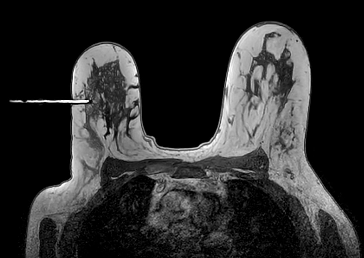 Axial 3D T1w FFE Needle positioning correct