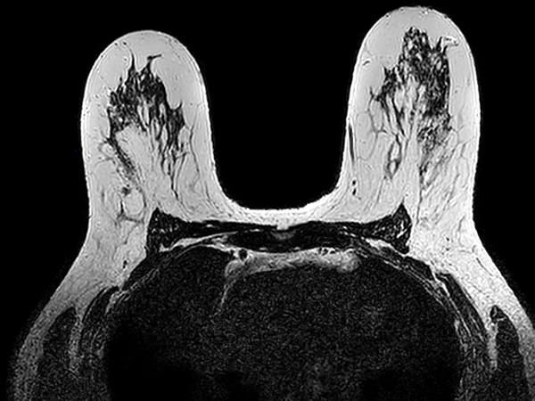 Axial 3D T2w BreastVIEW