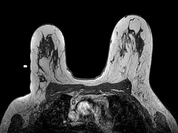 Axial dynamic 3D T1w FFE