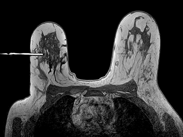 Axial 3D T1w FFE Needle positioning too deep