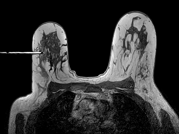 Axial 3D T1w FFE Needle positioning correct