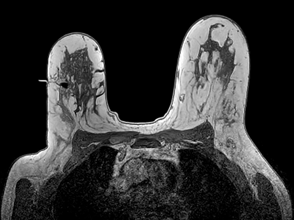 Axial 3D T1w FFE Post-biopsy check, clip inserted