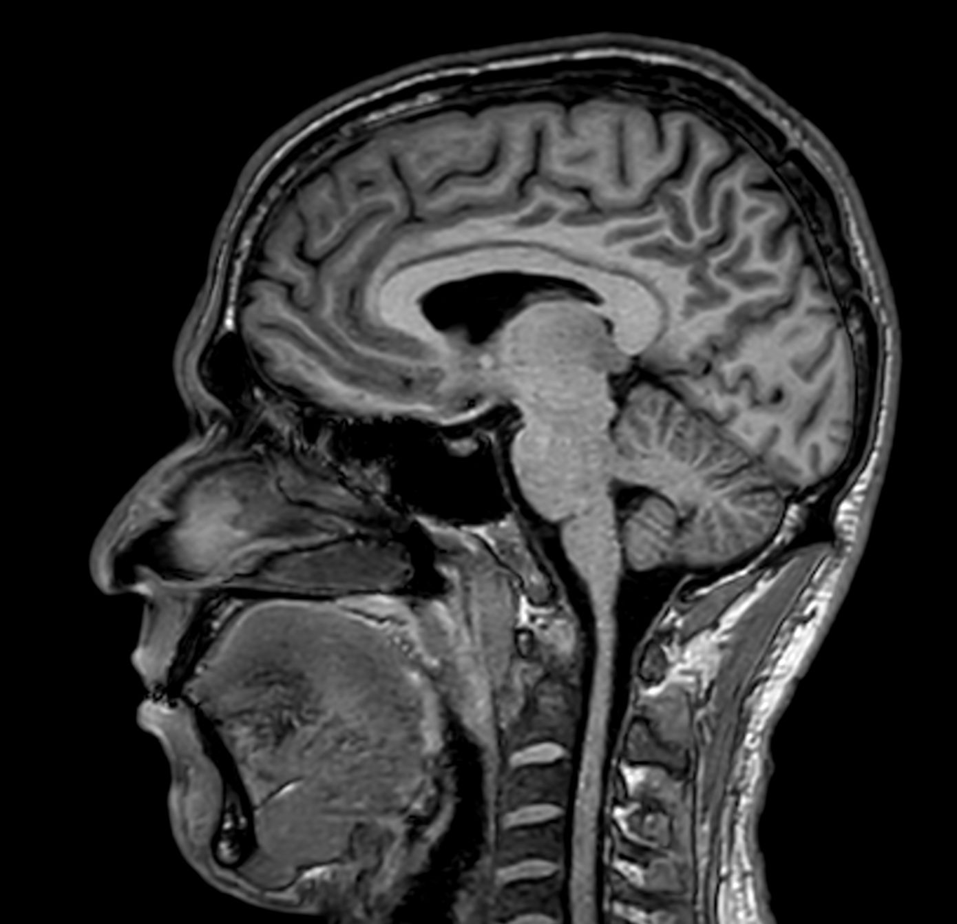 Sagittal 3D T1w TFE (MPRAGE)