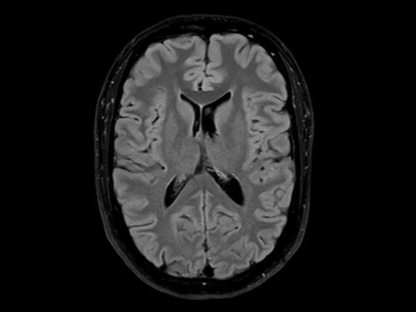 Axial T2w FLAIR