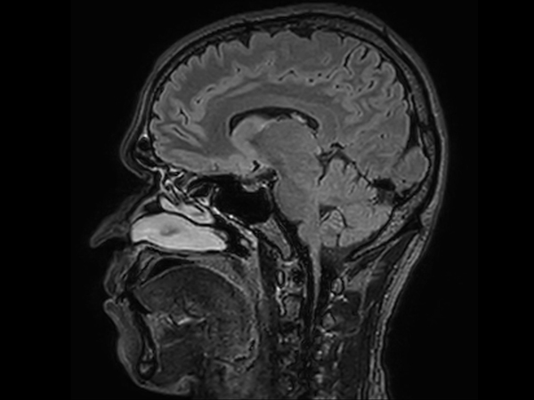 Sagittal 3D FLAIR