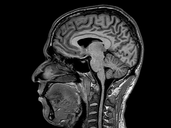 Sagittal 3D T1w TFE (MPRAGE)