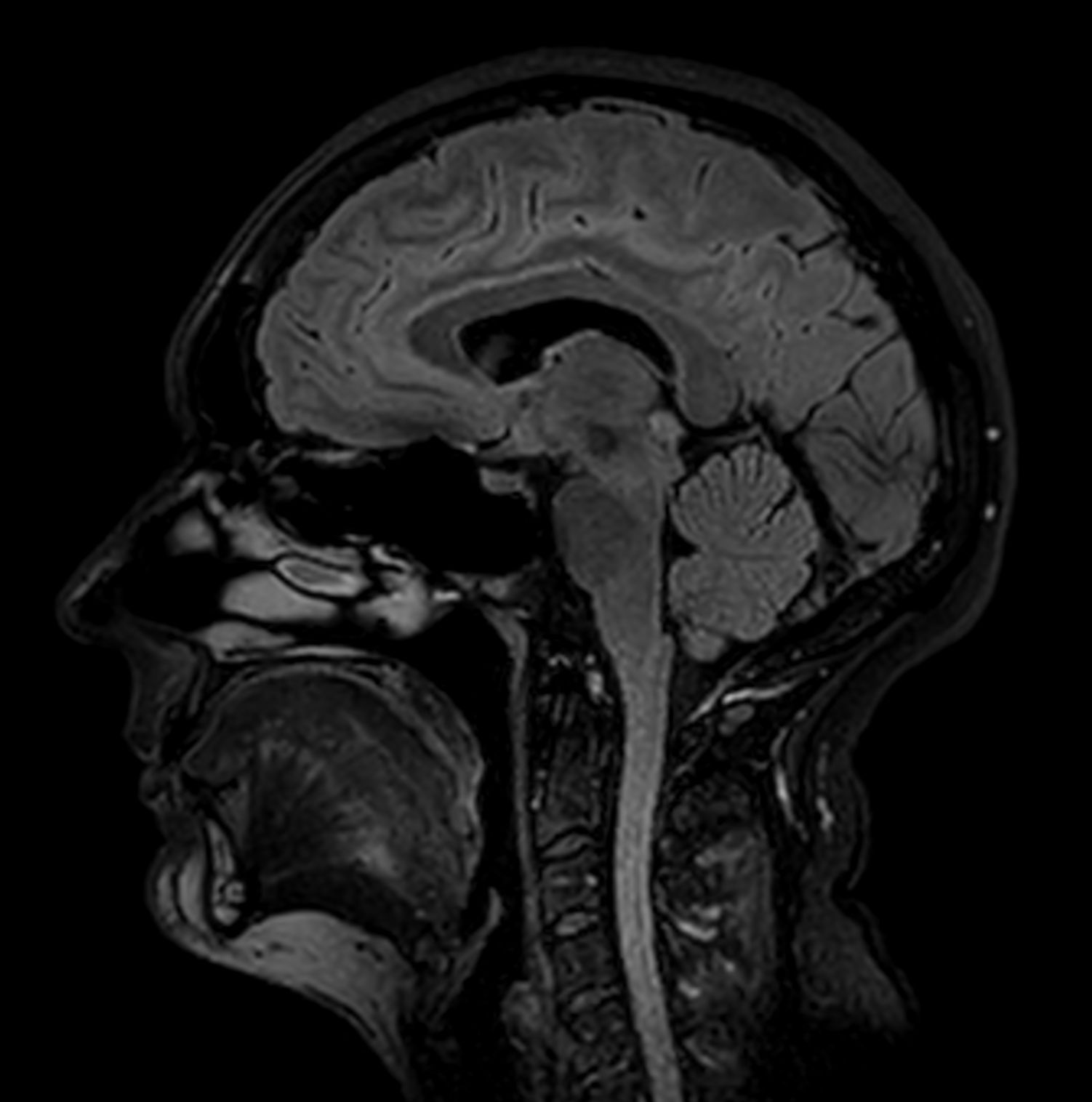 Sagittal 3D FLAIR