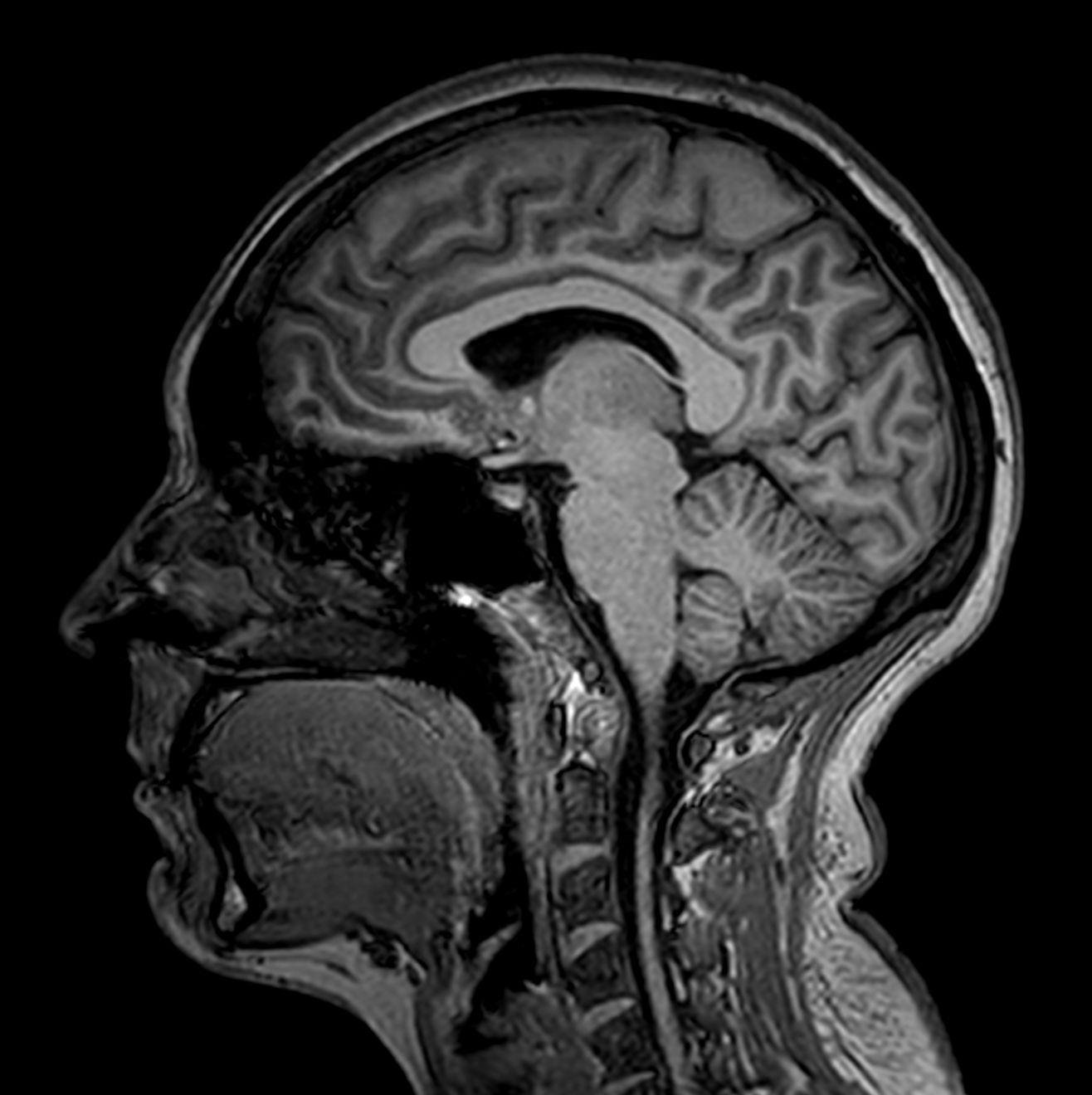 Sagittal 3D T1w TFE (MPRAGE)