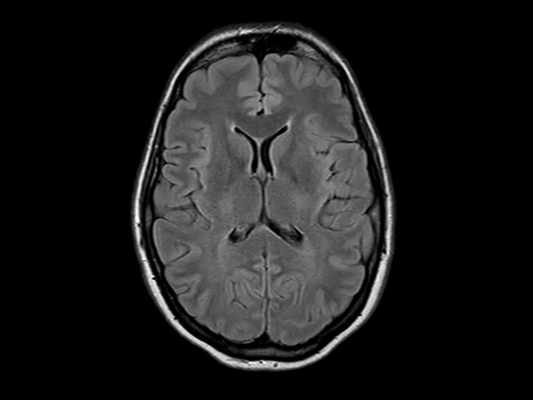 Axial T2w FLAIR