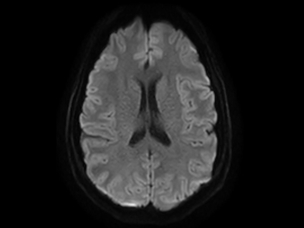 Axial DWI (b1000)