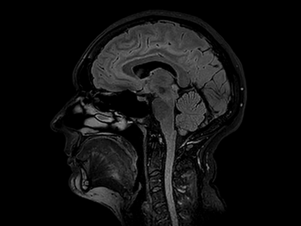 Sagittal 3D FLAIR