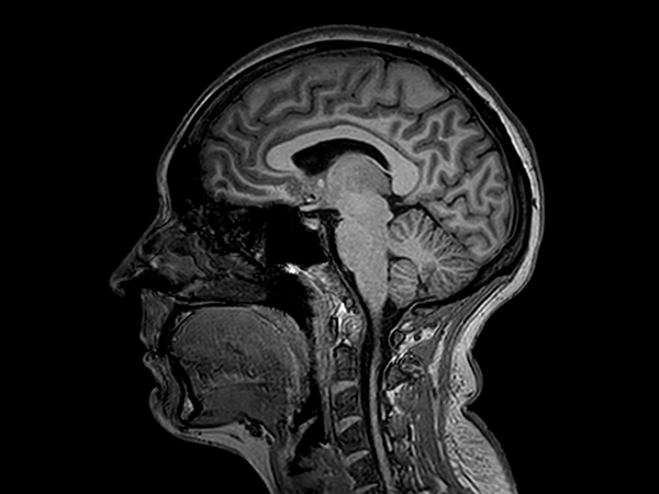 Sagittal 3D T1w TFE (MPRAGE)