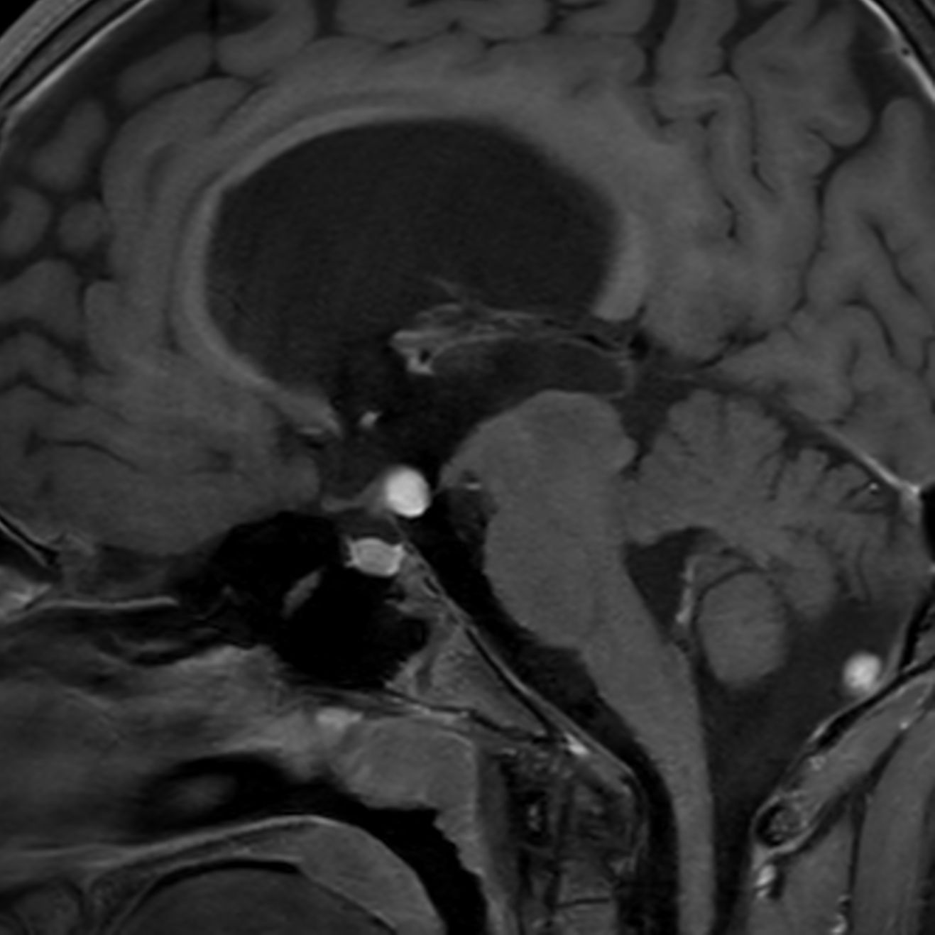 Sagittal 3D T1w Black Blood