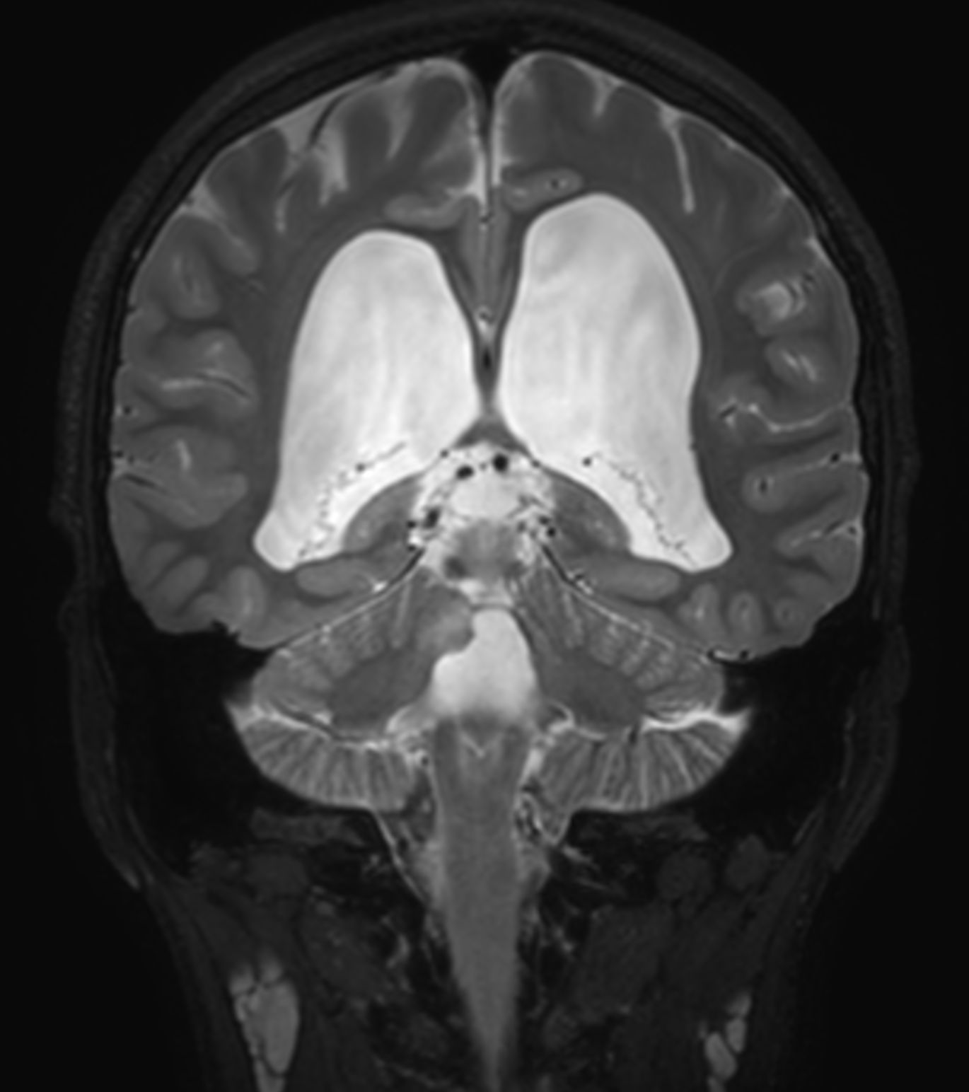 Coronal 3D T2w TSE (reformat)