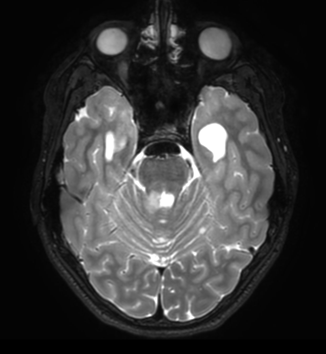 Axial 3D T2w TSE (reformat)
