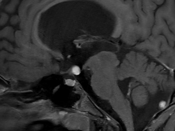 Sagittal 3D T1w Black Blood