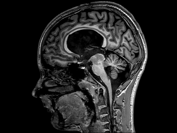 Sagittal 3D T1w TFE