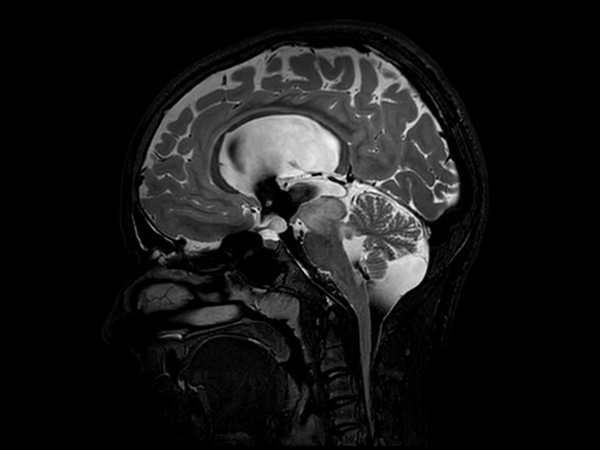Sagittal 3D T2w TSE