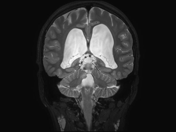 Coronal 3D T2w TSE (reformat)