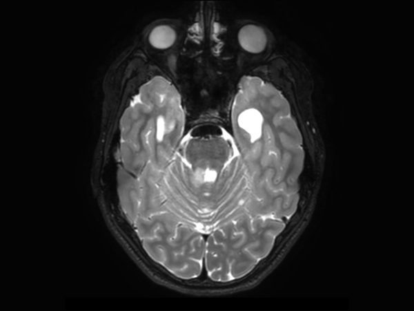 Axial 3D T2w TSE (reformat)