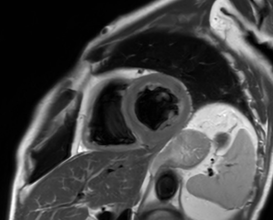 Black Blood Short Axis (Fast)