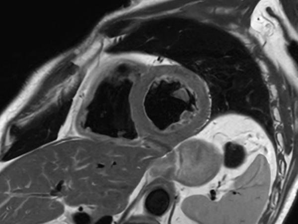 Black Blood Short Axis (High Res)