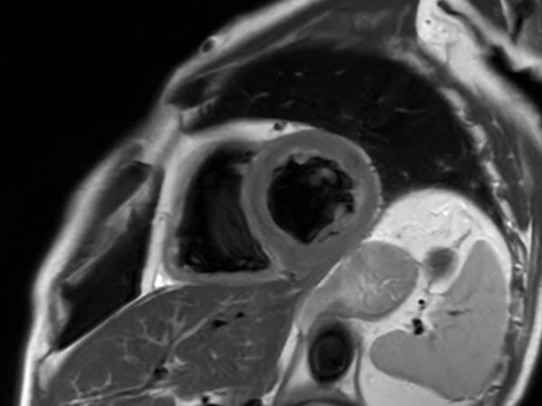 Black Blood Short Axis (Fast)