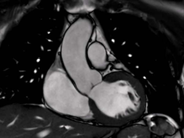 Coronal bTFE LVOT