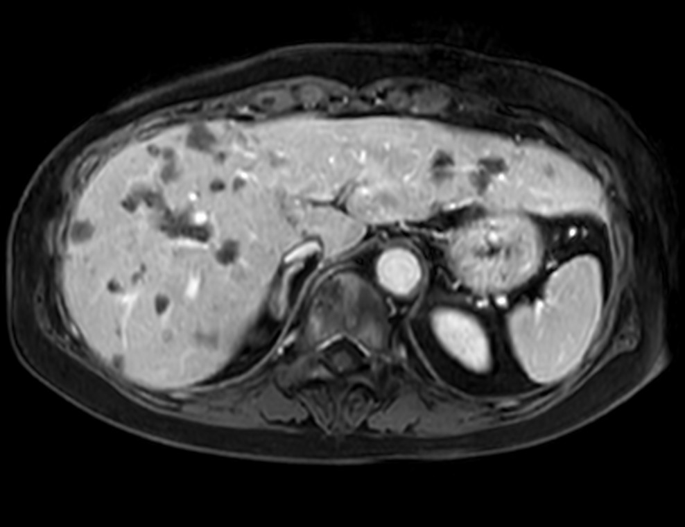 Axial eTHRIVE 90 sec Post gado