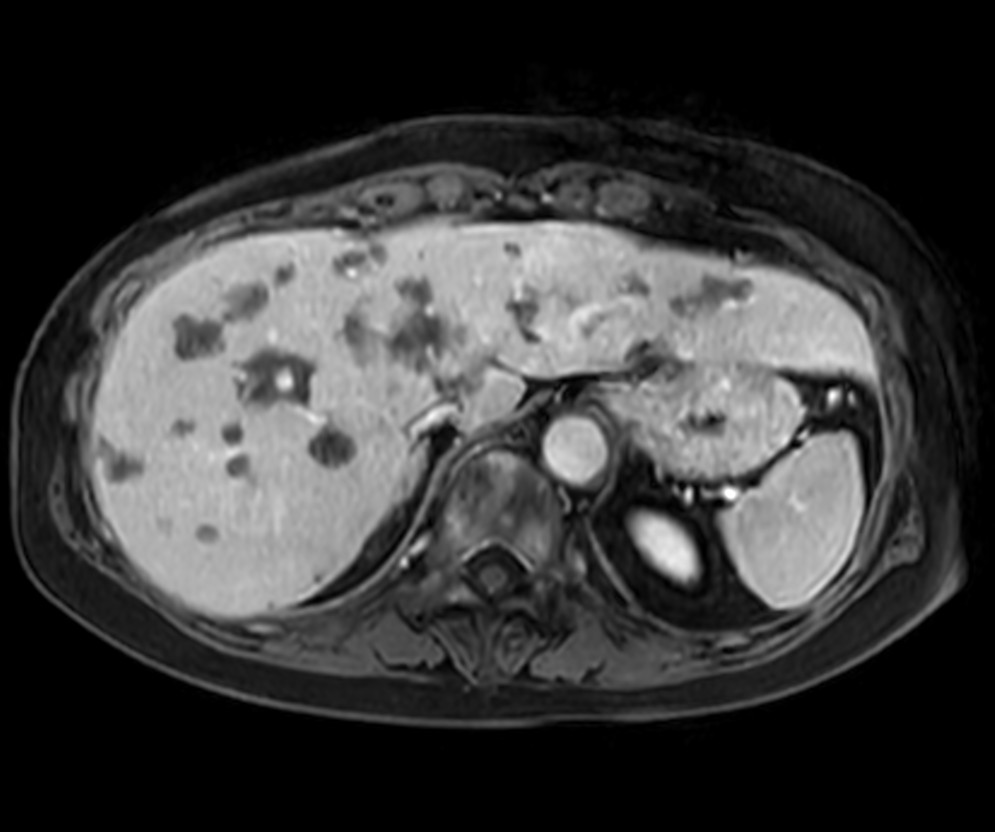 Axial eTHRIVE 2 min Post gado