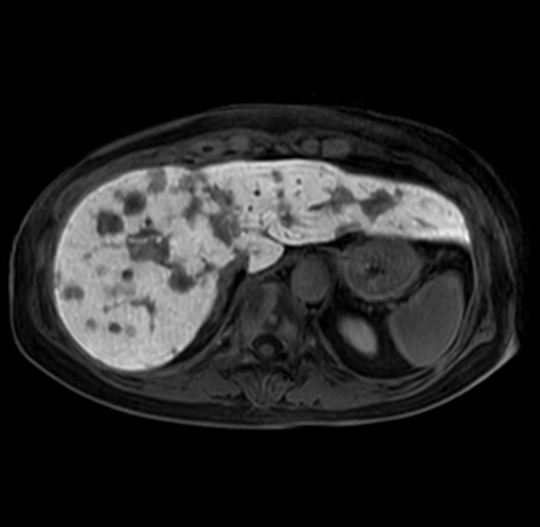 Axial eTHRIVE 15 min Post gado