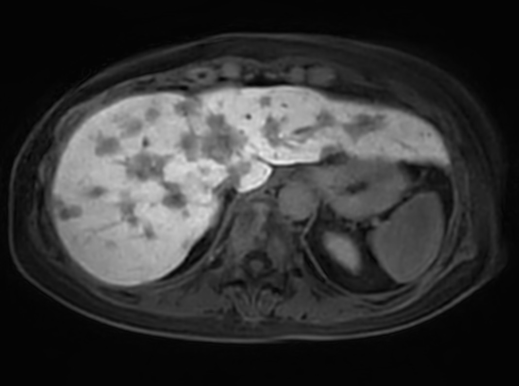Axial 3D VANE Post gado