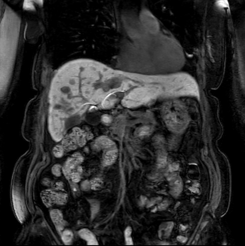 Coronal eTHRIVE Post gado