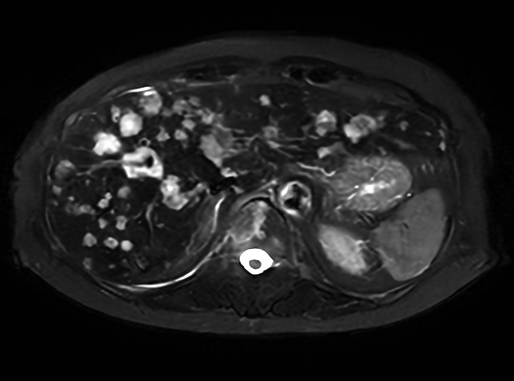 Axial Heavy T2w SSh FatSat