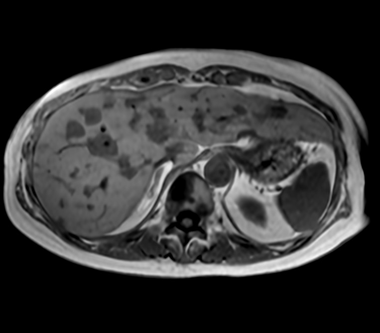 Axial T1w FFE (In Phase)