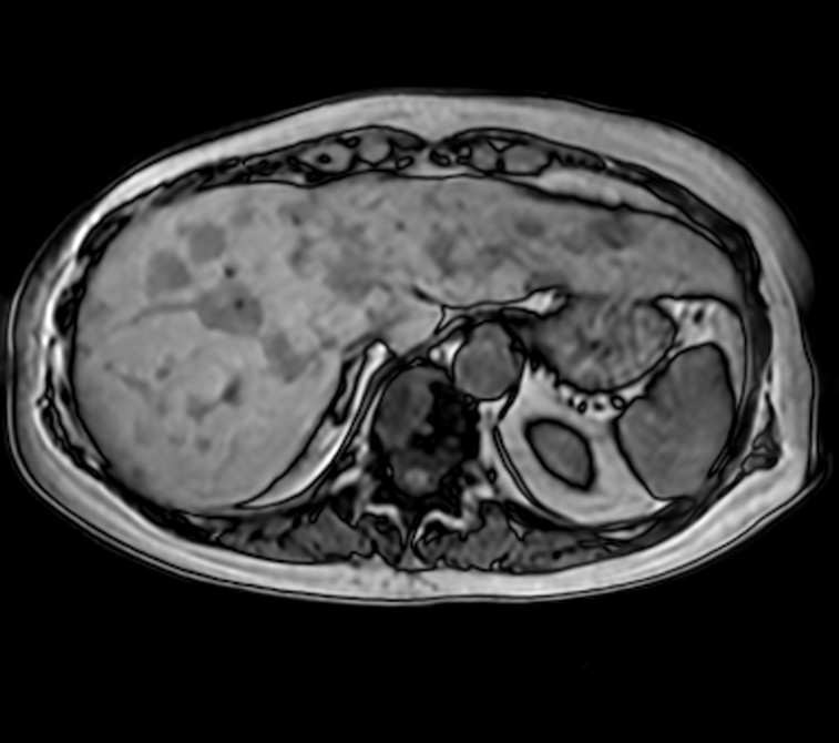 Axial T1w FFE (Out Phase)