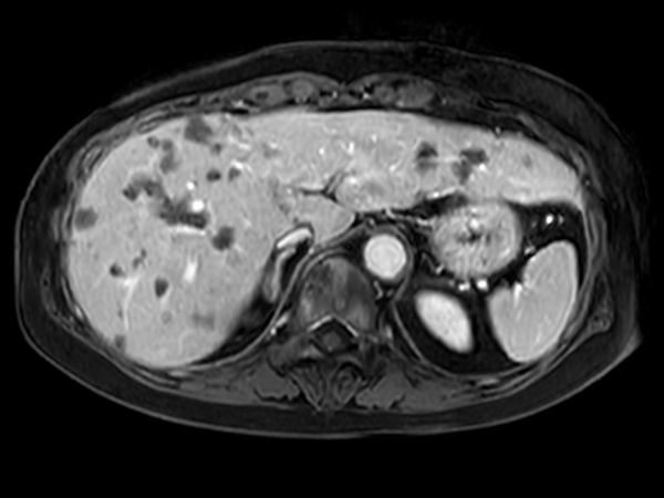 Axial eTHRIVE 90 sec Post gado