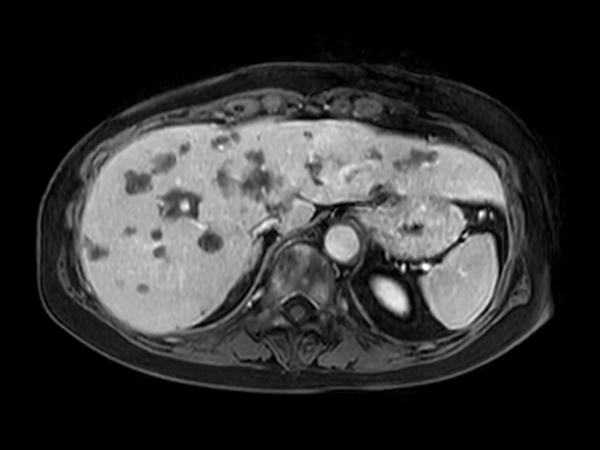Axial eTHRIVE 2 min Post gado