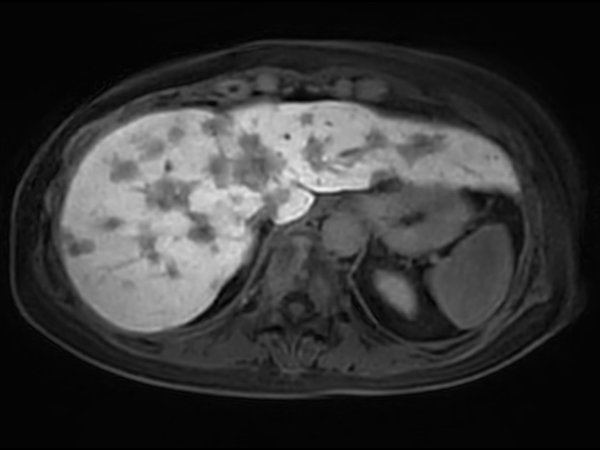 Axial 3D VANE Post gado