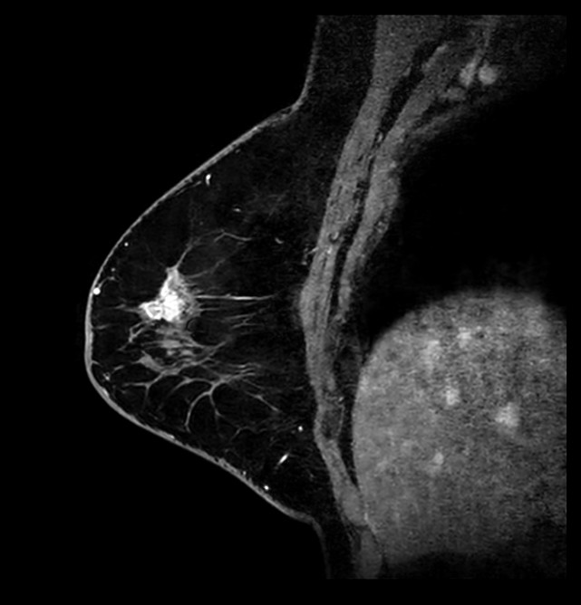 Sagittal 3D mDIXON gado (MPR)