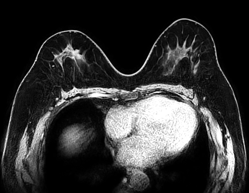 Axial T1w mDIXON FFE (Water only)