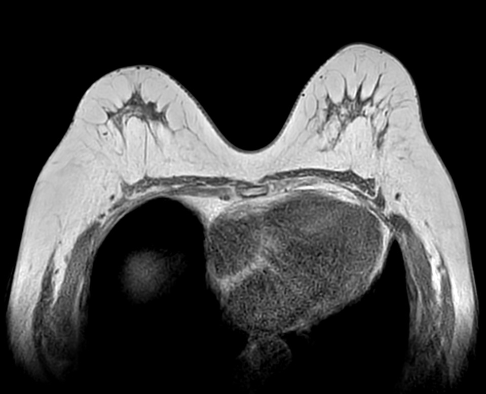 Axial T1w mDIXON FFE (In Phase)