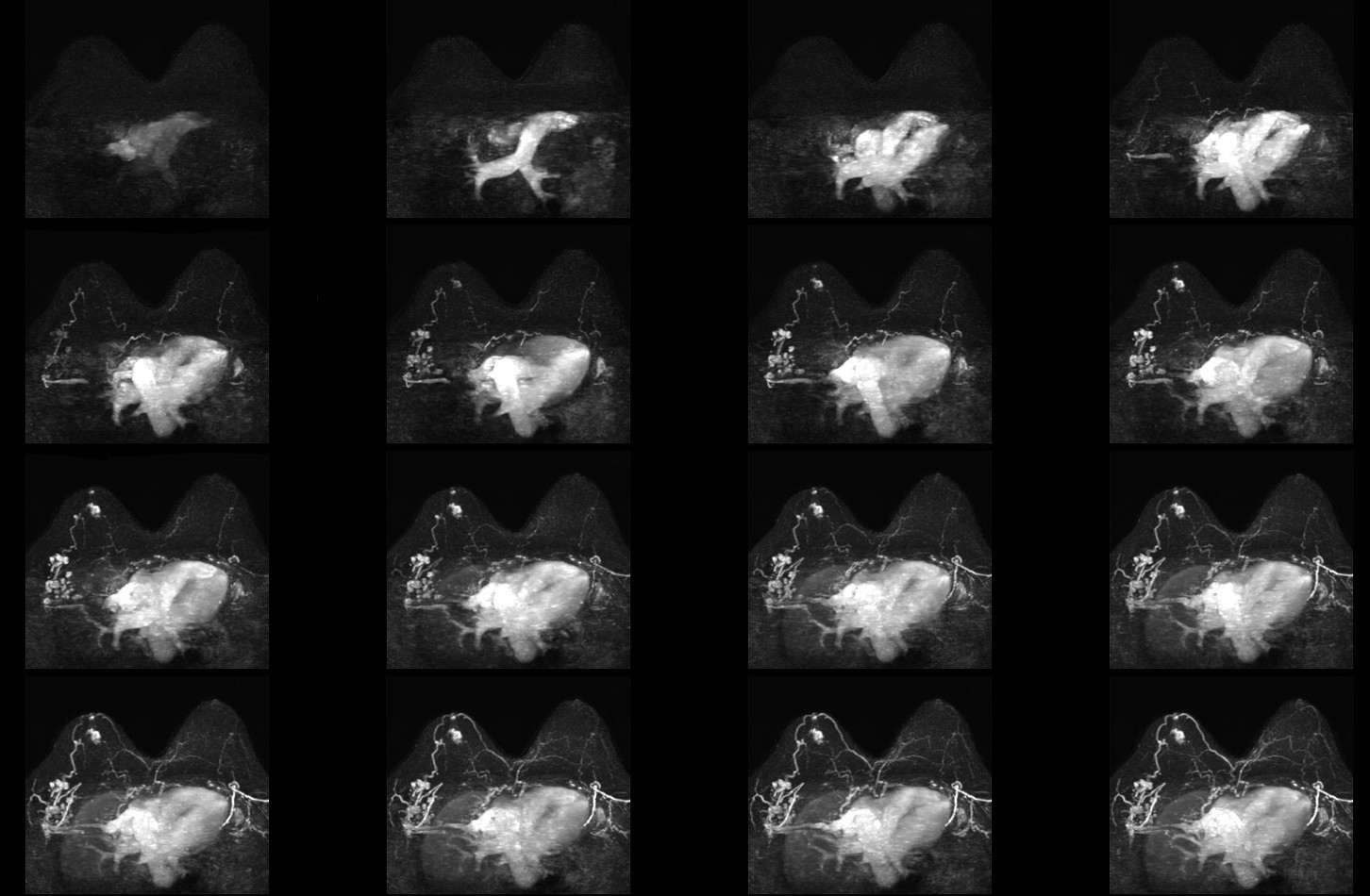 Dynamic T1w TFE (MIP)