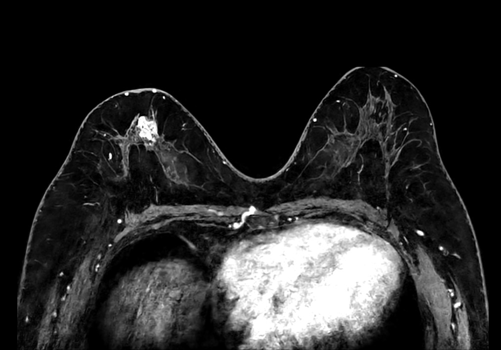 Axial 3D mDIXON gado (MPR)